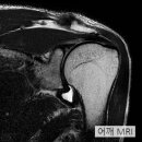 증상별 어깨질환 구분법 이미지