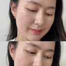 여드름크림 솔직 후기 : 아크네 엑스 크림 쿠피 추천