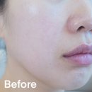 여드름 피부 크림, 메디<b>폴미</b> 리페어 크림으로 촉촉하게