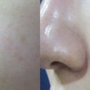 라임피부과 네이버블로그