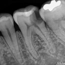 엔도코어 이미지