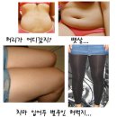 지방흡입 수술한지 20일째 이미지