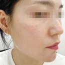 내동서울가정의학과의원 | [압구정 루나의원] 기미 잡티 루비레이저 후기