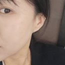 미금역 피부과ㅣ땅콩형 얼굴 대표원장님에게 상담 후 큐오필 후기(전/후 당일/3일/7일차 사진있음)