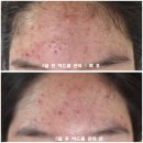 모녀의견 | 고1 사춘기 딸의 성난 염증성 여드름, 병원만이 답일까요? 퀸뷰티샵 모녀 여드름 관리 방문 후기
