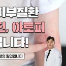 oo균이 피부질환(건선, 습진, 아토피)을 일으킨다!? 이미지