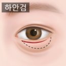 하안검수술후기, &#39;이것&#39;을 중점적으로 보세요