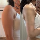 바보 | 팔뚝 지방흡입 2주차 통증 붓기 바본 후기 (붓기관리, 스트레칭, 부작용, 실밥 뽑기)