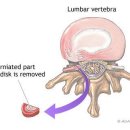 디스크 탈출증(HNP: herniated nucleus pulposus) 이미지