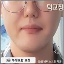 보우치과의원 | 치아 3급 부정교합 교정 장치 착용 기간 6개월 단축!