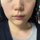 강남 청담 안면 윤곽 관리 - 보나트페이스 얼굴 비대칭, 광대 축소 관리 후기