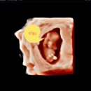 킴스의원 | [#임신기록] 8. 1차 기형아 검사 후기 | 속초킴스여성의원