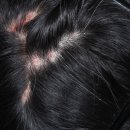 서강초교 | 지루성두피염부터 피지낭종 관리까지 신촌역탈모병원에서 치료받은 후기