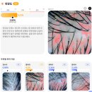 뽑기연구소 | [고잔동] 두피지컬연구소 안산점 문제성두피(지루성,염증성,건선) 케어 후기