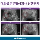 엉덩이통증이 심해서 병원에 갔더니 대퇴골두무혈성괴사?! 오늘 고관절인공관절에 대해 자세히 알아보겠습니다!!!!!!!! 이미지