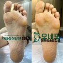 천안 굳은살 발각질 제거 전문 닥터아이티엔 천안점 오네또 이미지