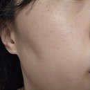 효성의원 | 10년만에 주근깨박멸 경산 삼북동 효성의원 주근깨레이저,편평사마귀 내돈내산 후기(+웨이팅, 민낮주의)