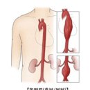 뇌동맥류는 두통·복시, 복부는 박동성 혹 만져지면 의심 이미지