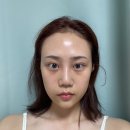 유니약국 | [유니풀의원 수원] 인계동 눈밑, 앞볼 필러 맛집 내돈내산(4일차)