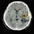 뇌 질환 의심될 때 저렴한 CT vs 비싼 MRI 이미지