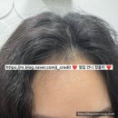 충남 천안 신부동 웰킨두피탈모센터신부점 붙임 머리 샴푸 스케일링 후기