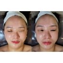 A1335 | [사하구다대포피부관리실]설레임에스테틱에서 세멘부스팅관리 받고 날렵턱선 얻다
