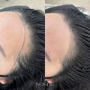 댕댕 shop(샵) | 청주 시내 헤어라인 | 자연스러운 헤어라인과 티 나는 헤어라인의 차이