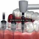 뿌리깊은치과의원 | 남양치과 잇몸이 붓고 아파서 갔는데 발치라니... 휘어있는 뿌리도 &#39;디지털 가이드&#39;로 정확하게...