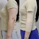 보루우 | 팔뚝지방흡입 내돈내산 생각보다 안 아파서 놀란 통증과 멍 변화 일주일차 리얼 후기
