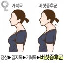 일자목 거북목 계속되면 우리의 몸은?? 이미지