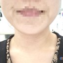 예신 결혼준비 온다리프팅 받으러 홍대피부과 다녀 왔어요