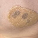 요새 핫하다는 리팟레이저로 흑자 말끔하게 제거한 후기