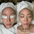 인천웨딩관리로 유명한 [스킨풀에스테틱] 인천문제성피부전문관리후기
