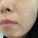 의정부 점빼기 유원의원에서 점뺀 후기