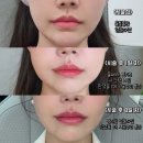 란사진실 | 울쎄라 가격 좋았던 울쎄라핏 300샷 유지기간 후기