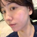 명동피부과 두 번째 방문 후기 얼굴제로팻후기