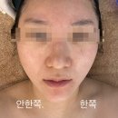 점촌5길 | 울산 구영리 피부관리 리즈에스테틱 바쿠나이젝션관리(MTS) 후기 및 효과