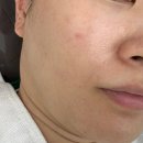 대구여드름 뉴에아뷰티 문제성피부관리