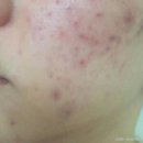 더마바이오테크놀로지사우스 | 반복되는 여드름 탈출 방법, 부평피부관리 솔직후기