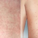 장미반점 이미지