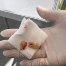 [🦷치과추천🦷] 역북 고릴라치과의원/ 사랑니 발치/ 1도 안 아픔.