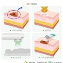 안면부 기저세포암[44.9] 최종진단을 받은 경우 일반암을 받을 수 있습니까? 이미지