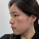 미희수입 | 홍대피부과 뉴라미스 이마필러5CC 미희주사 눈밑후기