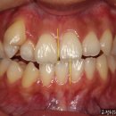 경우 | 치아교정으로 비대칭 개선이 가능한 경우 후기(교정 vs 수술)