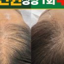 렛미인X모리바이브두피탈모