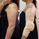 여리약국 | 광명 뒷볼록 지방추출주사 당일후기 | 팔 통증 붓기 바본 일상생활