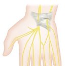 &#34; 손목터널증후군 &#34; (Carpal tunnel syndrome) 이미지