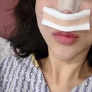 달전약국 | 코수술후기 코밍아웃 👃🏻 _ 작은 코, 코수술 아바타코 붓기템, 코성형1~14일 2주차 기록