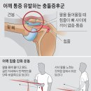 어깨 통증 &#39;초기 진압&#39;하려면… 힘줄 덮은 근육 단련을 이미지