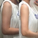달아래행복 | 예신들에게 강력추천! 대구 지방추출주사 후 두달차 후기